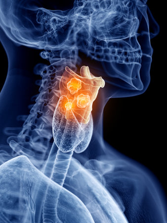 3d rendered, medically accurate illustration of larynx cancerの写真素材