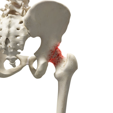 3d rendered medically accurate illustration of an arthritic hip jointの写真素材