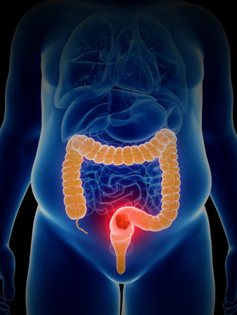 3d rendered, medically accurate illustration of colon cancer