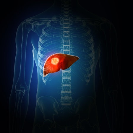 3d rendered medically accurate illustration of liver cancerの写真素材