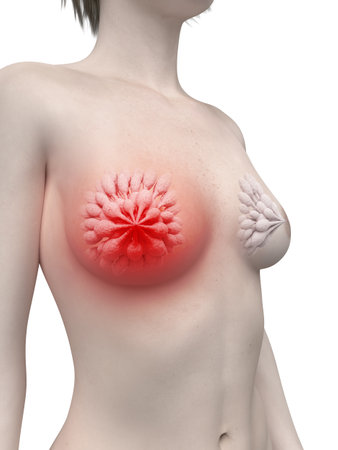 3d rendered medically accurate illustration of inflamed mammary glandsの写真素材