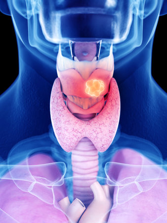 3d rendered medically accurate illustration of larynx cancerの写真素材