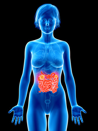medically accurate 3d rendering of a femaleÂ´s small intestine cancerの写真素材