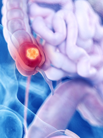 3d rendered medically accurate illustration of colon cancer