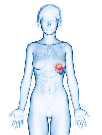 medically accurate 3d rendering of a femaleÂ´s spleen cancerの写真素材