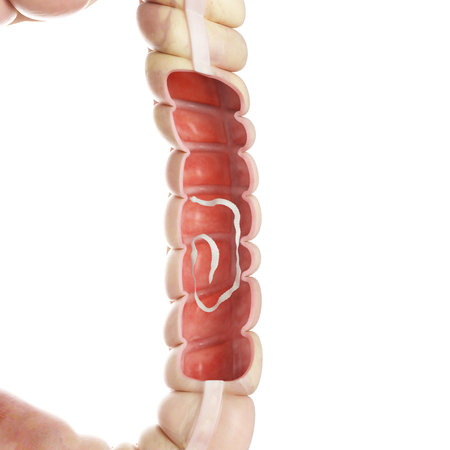 3d rendered medically accurate illustration of a tapeworm in the large intestineの写真素材