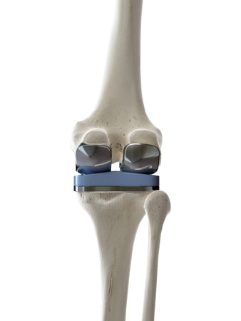 3d rendered medically accurate illustration of a knee replacement