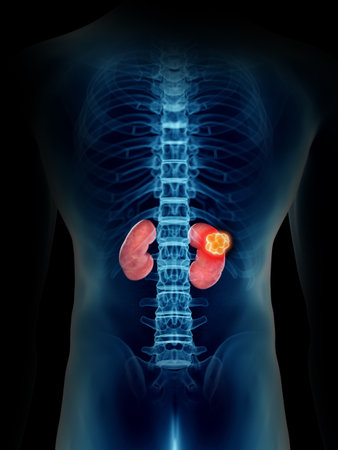 3d rendered medically accurate illustration of a mans kidney tumor