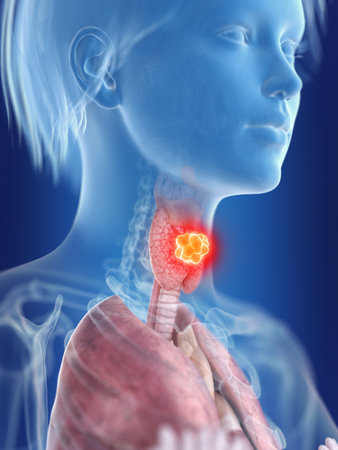 3d rendered medically accurate illustration of a womans thyroid gland cancer