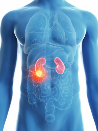 3d rendered medically accurate illustration of a mans kidney cancer