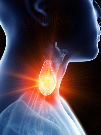 3d rendered medically accurate illustration of a mans thyroid gland cancer