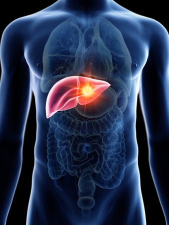 3d rendered medically accurate illustration of a mans liver cancerの写真素材