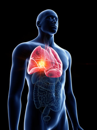 3d rendered medically accurate illustration of a mans lung tumorの写真素材