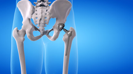 3d rendered medically accurate illustration of a hip replacementの写真素材