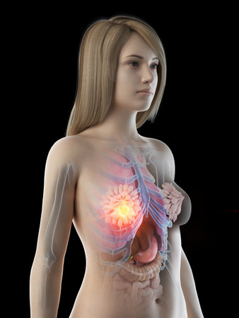 3d rendered medically accurate illustration of breast cancer