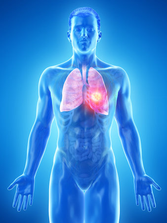 3d rendered medically accurate illustration of a mans lung tumorの写真素材