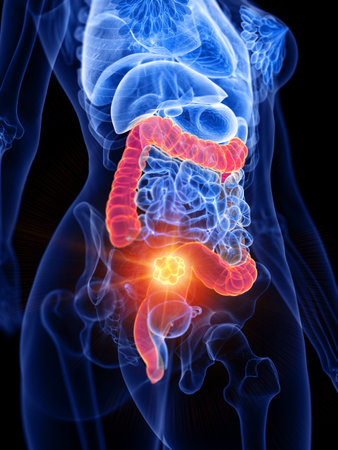 3d rendered medically accurate illustration of a womans large intestine tumorの写真素材