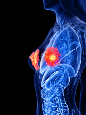 3d rendered medically accurate illustration of a womans mammary glands tumorの写真素材