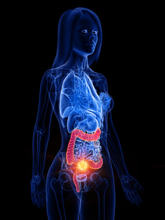 3d rendered medically accurate illustration of a womans large intestine tumorの写真素材