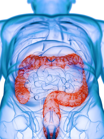 3d rendered medically accurate illustration of a diseased colon