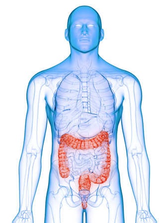 3d rendered medically accurate illustration of a diseased colon