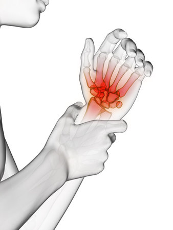 3d rendered medically accurate illustration of painful wristの写真素材