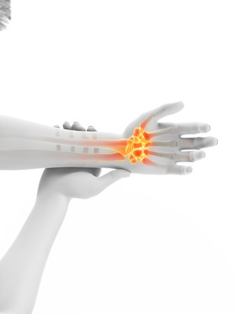 3d rendered medically accurate illustration of a man having a painful wristの写真素材