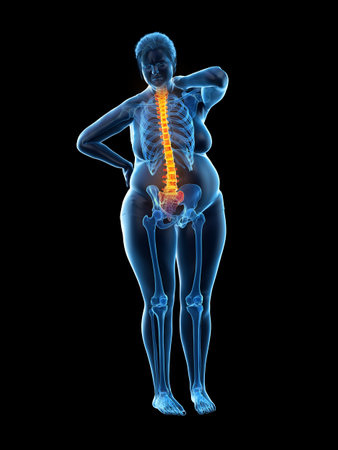 3d rendered medically accurate illustration of an overweight womans painful back
