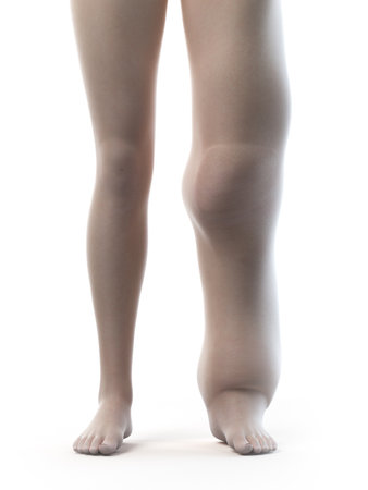 3d rendered medically accurate illustration of a lymphedemaの写真素材
