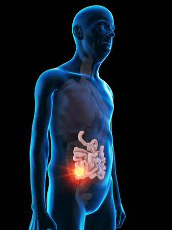 3d rendered medically accurate illustration of an old mans small intestine tumor
