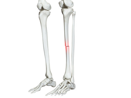 3d rendered medically accurate illustration of a broken tibia