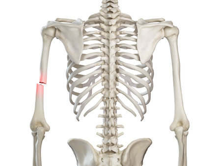 3d rendered medically accurate illustration of a broken humerusの写真素材