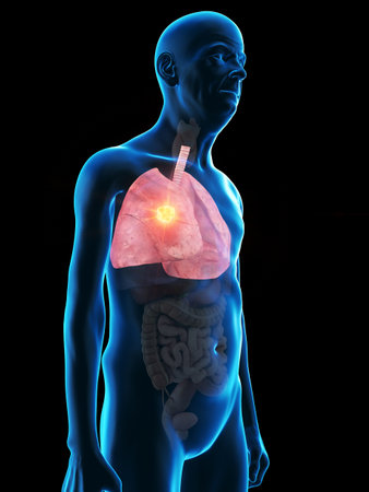 3d rendered medically accurate illustration of an old mans lung tumorの写真素材