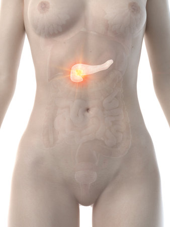 3d rendered medically accurate illustration of a womans pancreas cancerの写真素材