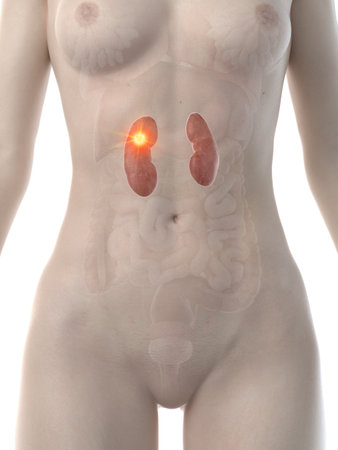 3d rendered medically accurate illustration of a womans kidneys cancerの写真素材