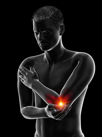 3d rendered medically accurate illustration of a painful elbowの写真素材