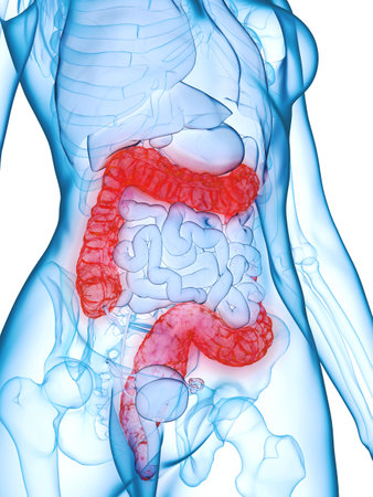 3d rendered medically accurate illustration of a diseased colonの写真素材