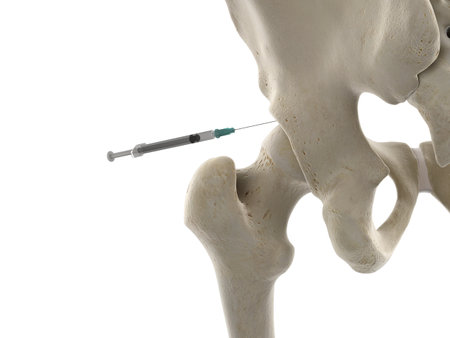 3d rendered medically accurate illustration of a hip joint injectionの写真素材