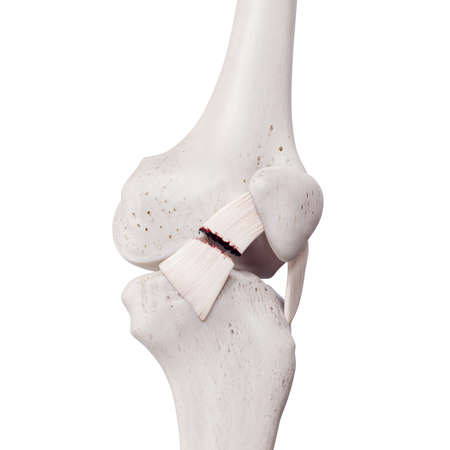 3d rendered medically accurate illustration of a torn medial patellar ligament