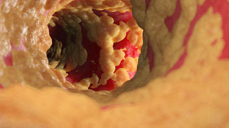 3d rendered illustration of a fatty human arteryの写真素材