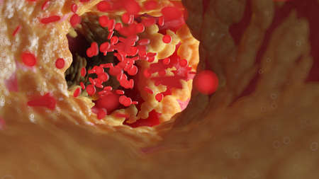 3d rendered illustration of a fatty human arteryの写真素材