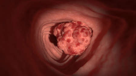 3d rendered illustration of colon tumors