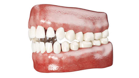 3d rendered illustration of an open bite