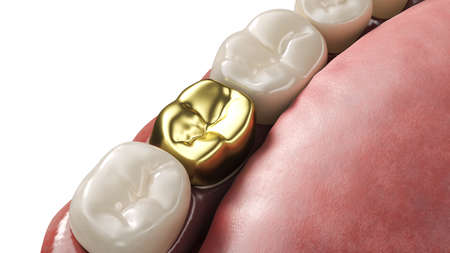 3d rendered illustration of a dental crown