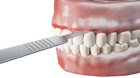 3d rendered illustration of a fiberotomy