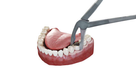 3d rendered illustration of a tooth extraction