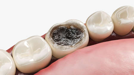 3d rendered illustration of tooth decay