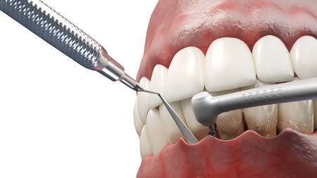 3d rendered illustration of dental pocket reduction
