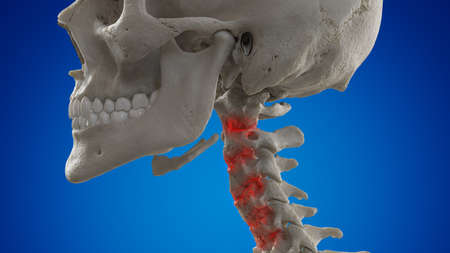 3d rendered illustration of an arthritic cervical spine