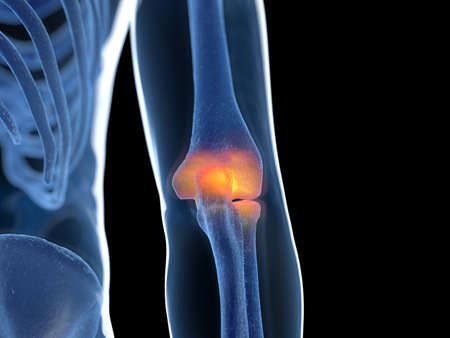 3d rendered illustration of an inflamed elbow jointの写真素材